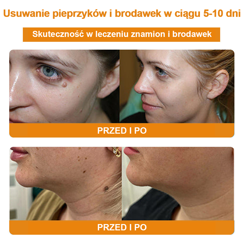 修改💥𝑻𝒖𝒓𝒐𝒏𝒖™Velim Jędom Odsłanenię Bradavič Znamionok Krem (🧑‍⚕️AAD Rekomenduje)🐝🐝(🔥Promocja ostatniego dnia - 70% rabatu)🔥💥 (Copy)