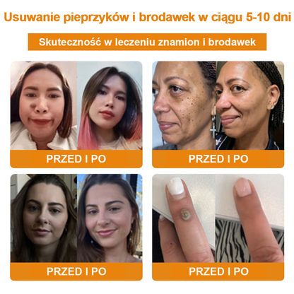 修改💥𝑻𝒖𝒓𝒐𝒏𝒖™Velim Jędom Odsłanenię Bradavič Znamionok Krem (🧑‍⚕️AAD Rekomenduje)🐝🐝(🔥Promocja ostatniego dnia - 70% rabatu)🔥💥 (Copy)