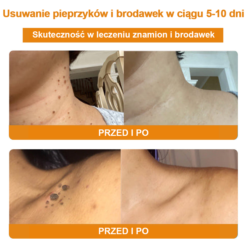 修改💥𝑻𝒖𝒓𝒐𝒏𝒖™Velim Jędom Odsłanenię Bradavič Znamionok Krem (🧑‍⚕️AAD Rekomenduje)🐝🐝(🔥Promocja ostatniego dnia - 70% rabatu)🔥💥 (Copy)